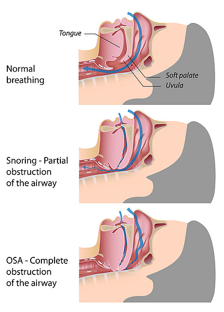 How to Stop Snoring