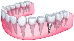 Dental Implants Waco Texas