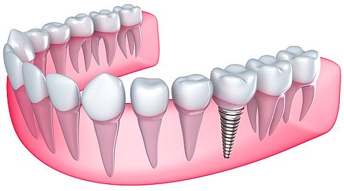 Dental Implants in Waco