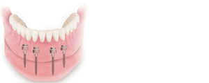 Mini Dental Implants in Waco - Waco Family Dentistry