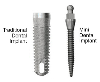 Traditional vs. Same Day Implants