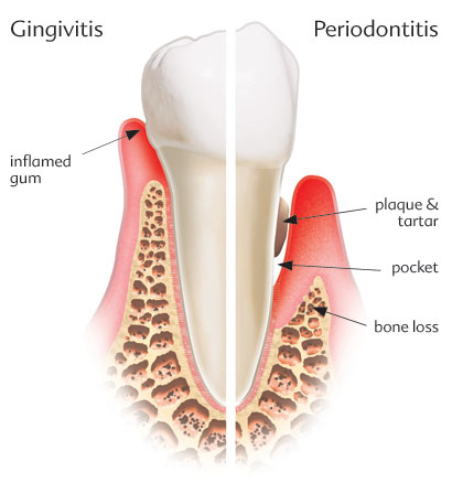 Periodontal Disease